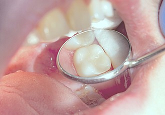Tooth preservation | Fillings