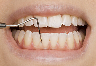 Periodontology  | Gum treatment