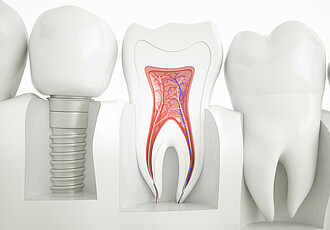 Implantologie | Künstliche Zähne