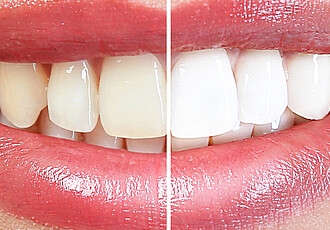 Zahnästhetik | Bleaching