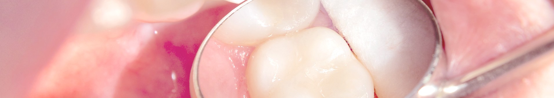 Für Inlay-Versorgung empfehlen wir die CEREC-Methode, einer modernen, computergestützten Zahnmedizin.