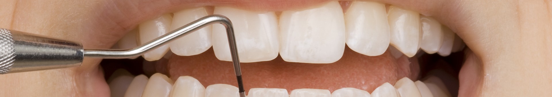 In der Parodontalen Erhaltungstherapie (PET) erfolgt nach der professionellen Zahnreinigung eine medikamentöse Behandlung der Zahnfleischtaschen.