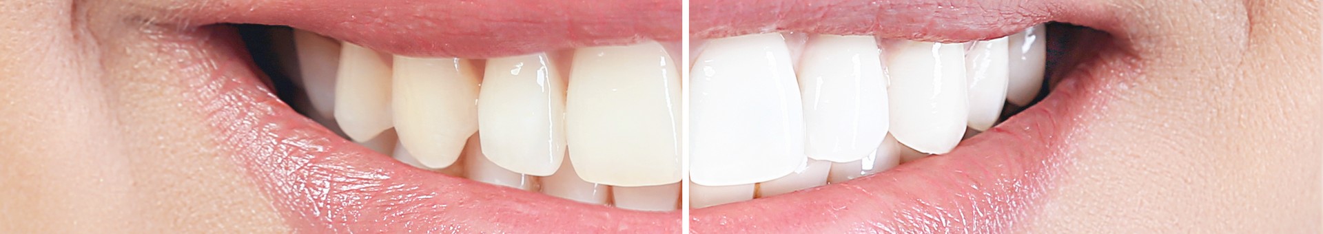 Bei diesem Aufhellungsverfahren wird meist ein spezielles Gel auf die Zähne aufgetragen, dessen Wirkstoff in den Zahn eindringt und dort die dunklen Farbmoleküle „entfärbt“.